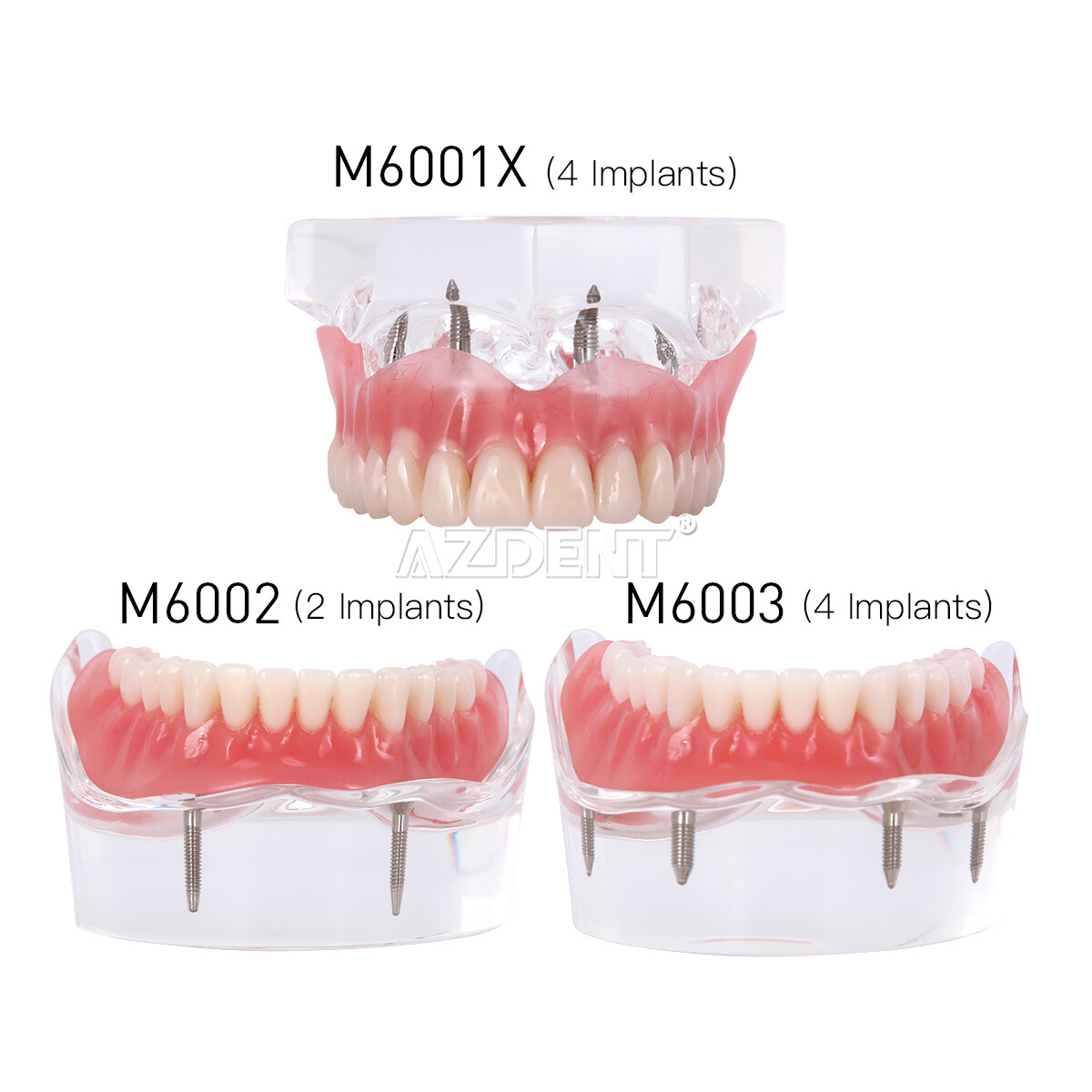 Dental Implant Teeth Model Demo Overdenture Restoration with Implants U/L 2 4