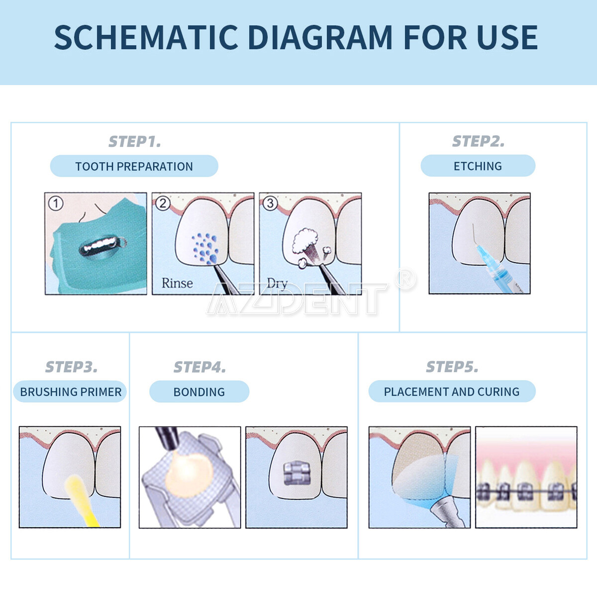 Dental Orthodontic Light Cure Adhesive Bonding Curing Paste Etchant Gel Kit