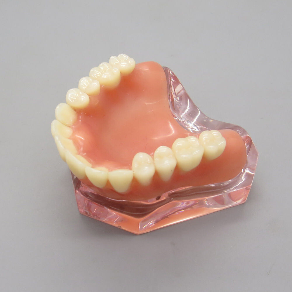 Dental High Quality Model of Upper Teeth Dentures Superior 4 Implants Maxillary