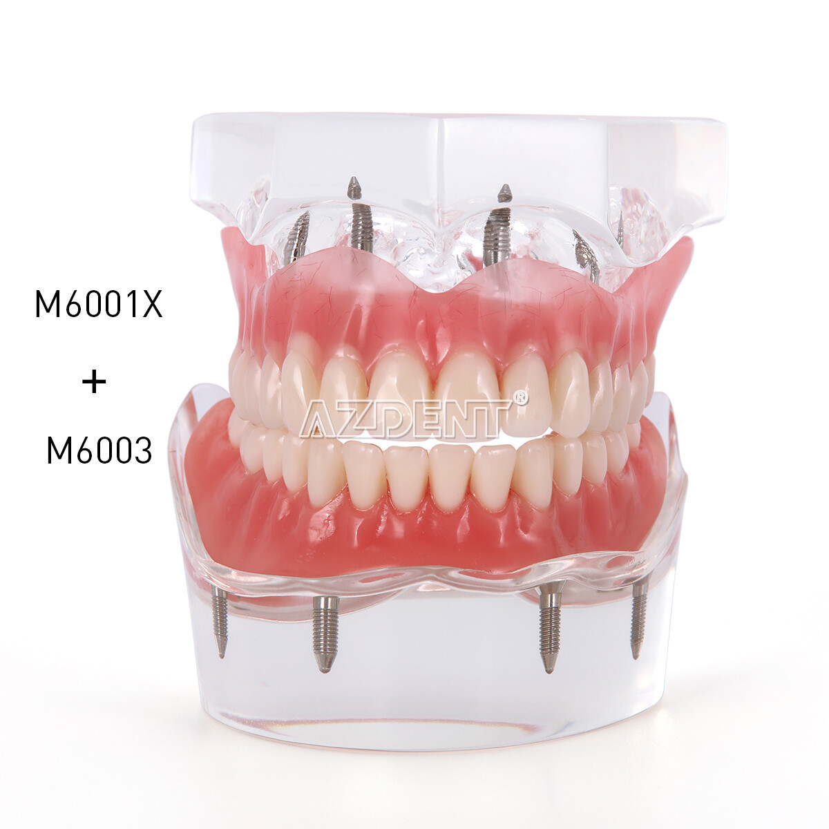 Dental Implant Teeth Model Demo Overdenture Restoration 2 / 4 Implants Upper Low