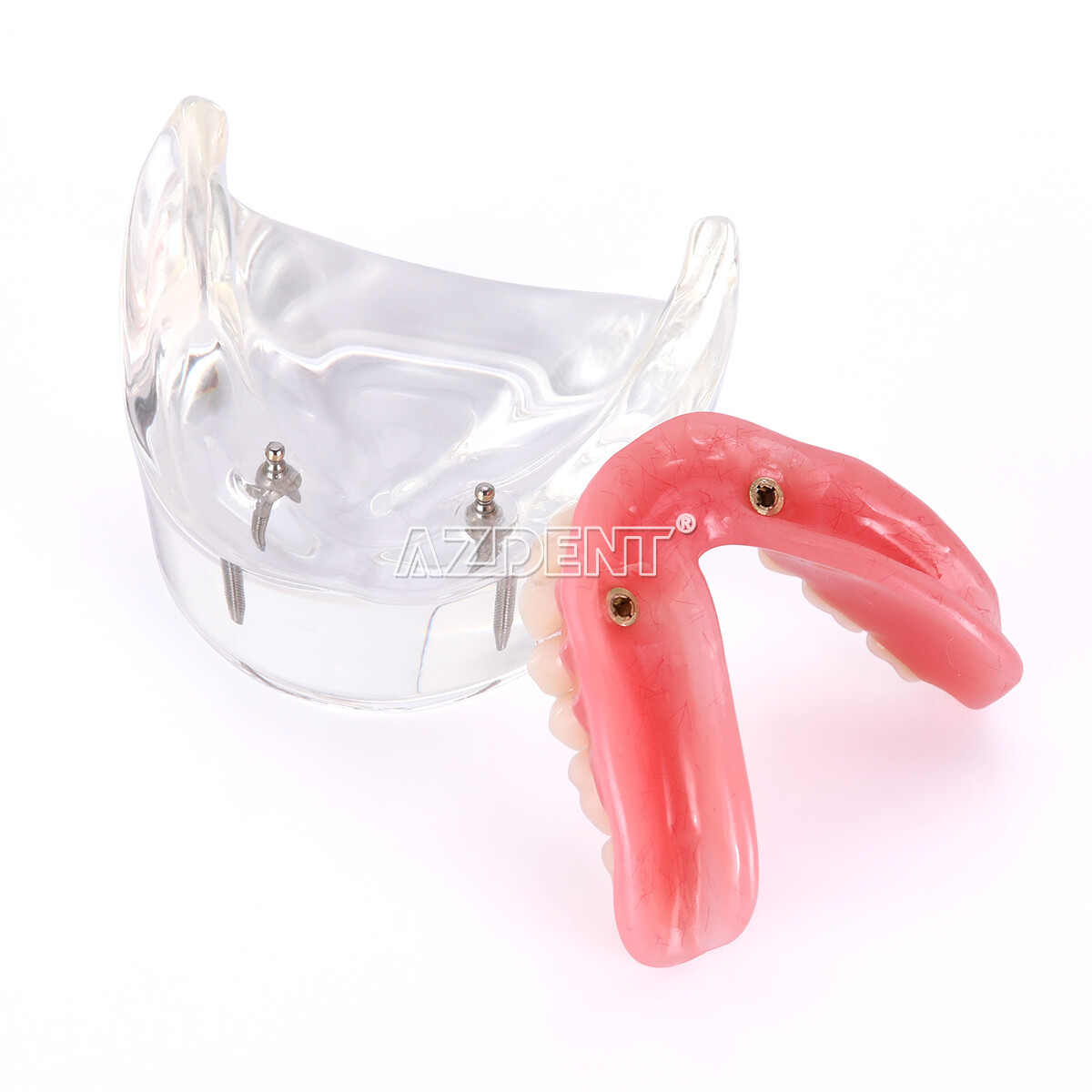 Dental Implant Teeth Model U/ L Demo Overdenture Restoration w/ 2 4 Implants