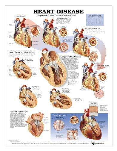 HEART DISEASE Laminated Wall Chart 20″ x 26″ Classroom/Professional LFA #99912