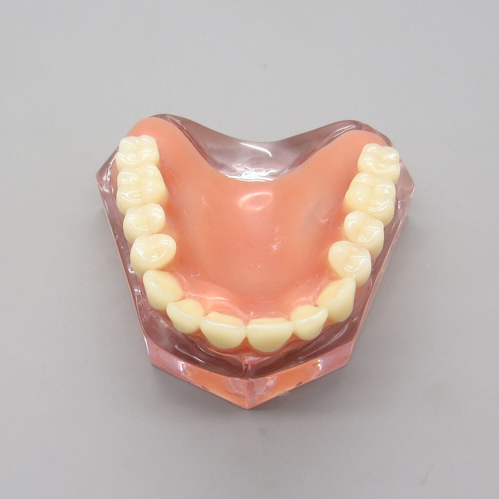 Dental High Quality Model of Upper Teeth Dentures Superior 4 Implants Maxillary