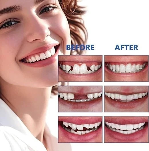 Teeth, Tooth Replacement Missing Teeth, Teeth Permanent Filling Kit & Tool, 50ML