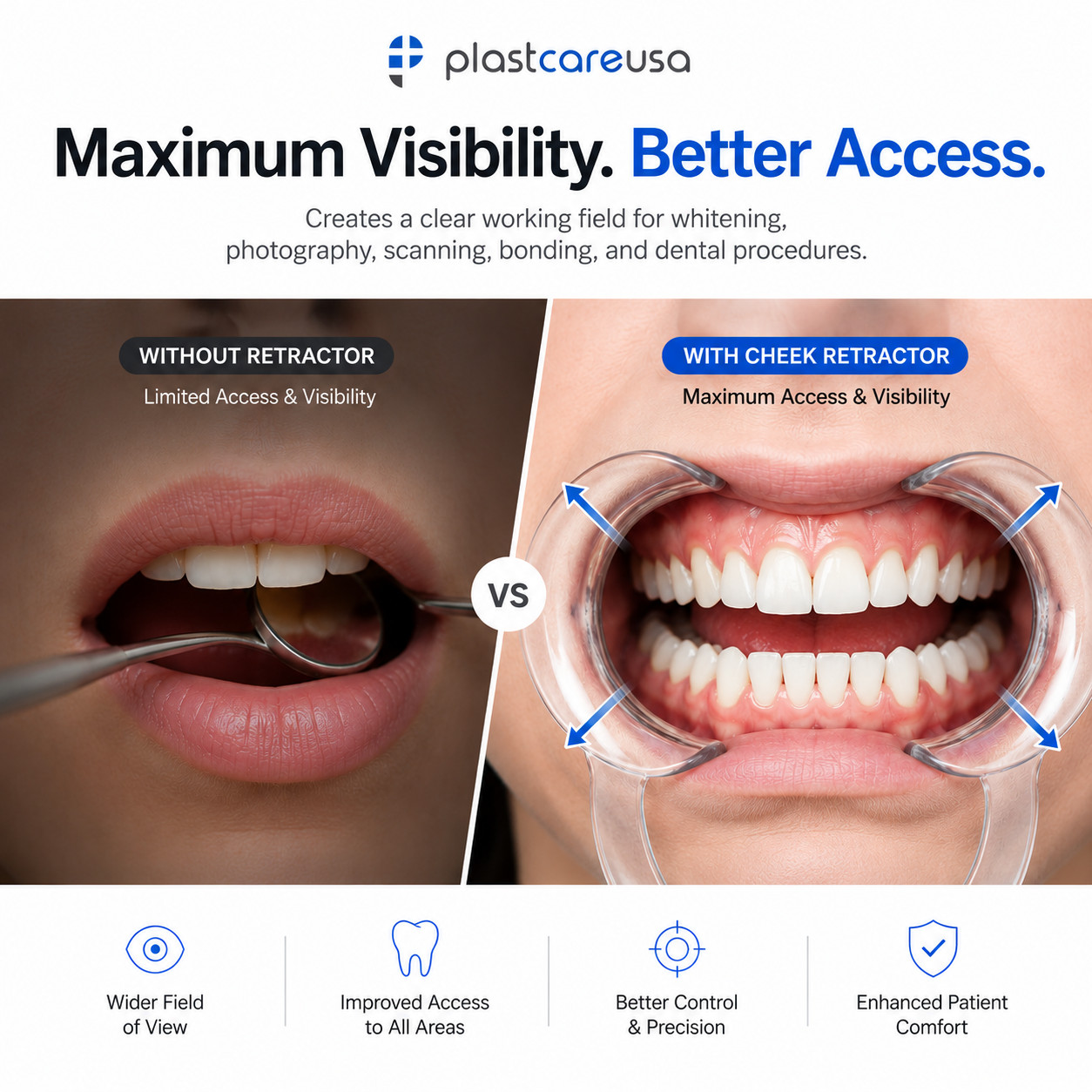 80 Large Teeth Whitening Cheek Retractor, Autoclavable Dental Mouth Opener Game