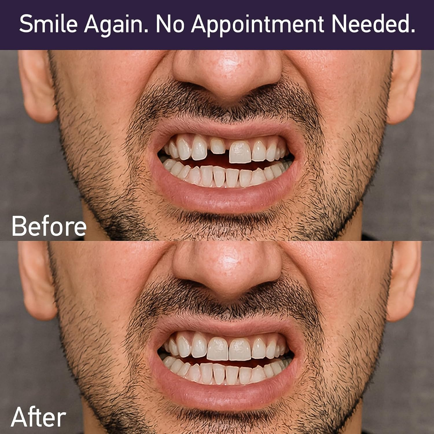 Dental Cement Kit – Zinc Oxide Eugenol Temporary Filling & Crown Repair | Tooth