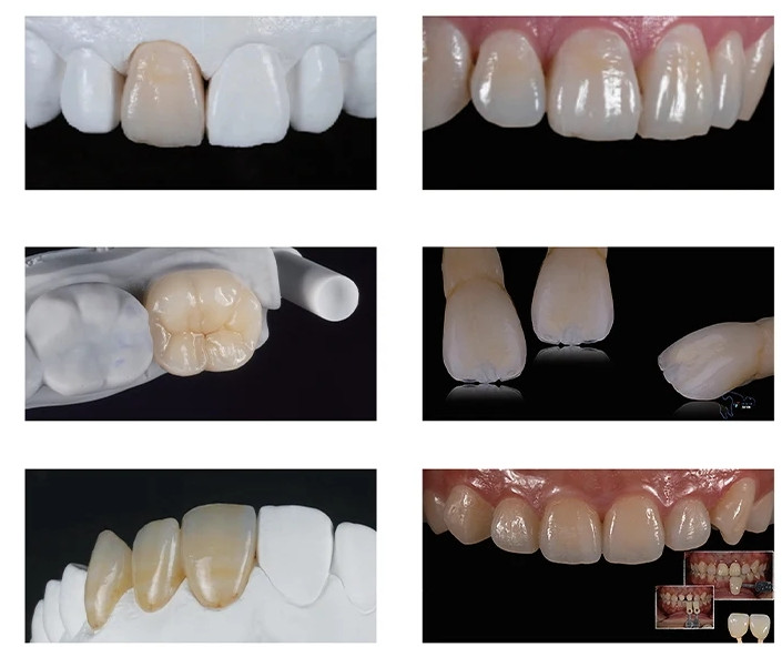 C14 Dental Emax CAD/CAM CEREC Ceramic Blocks Lithium Disilicate Block – 5pcs/Box