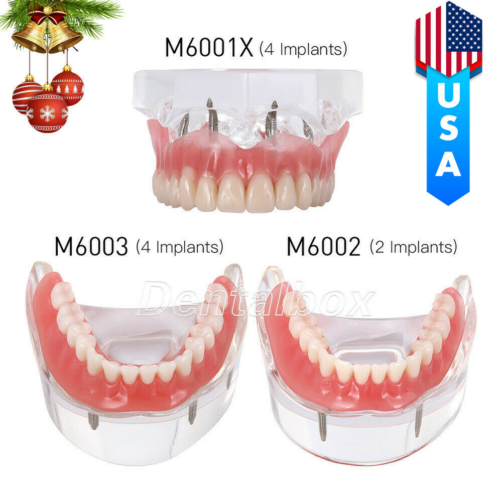 US Dental Implant Teeth Model Demo Overdenture Restoration With Implants U/L