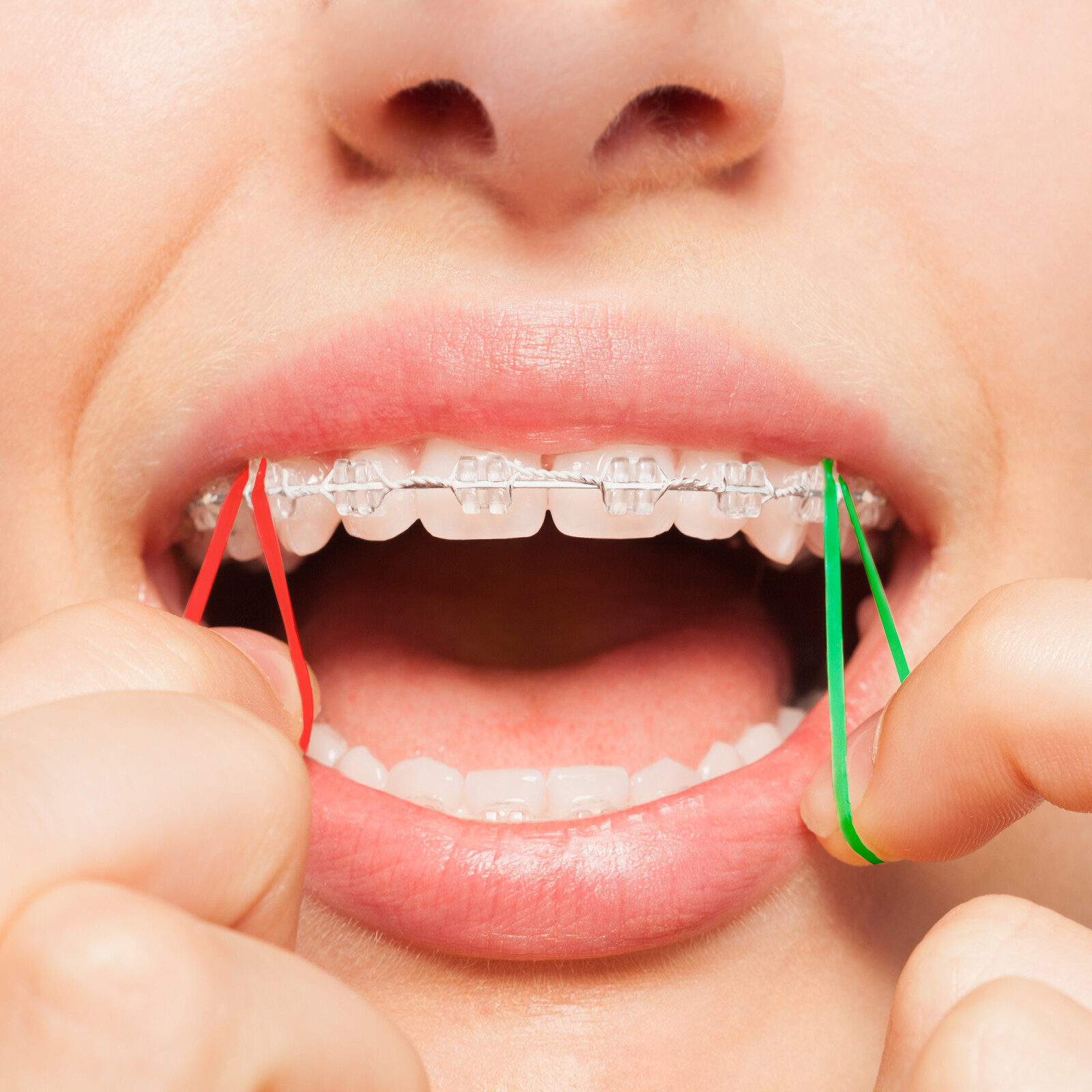 Close Teeth Gaps Orthodontic Neon Intraoral Elastic Bands Non-Latex Made In USA