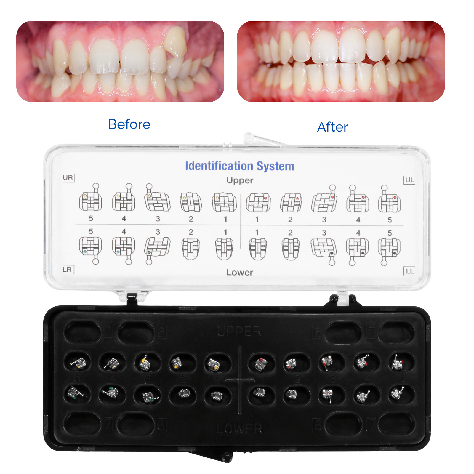 20Pcs Dental Orthodontic Brackets Braces Mini Roth MBT 018/022 Hooks 345 Metal