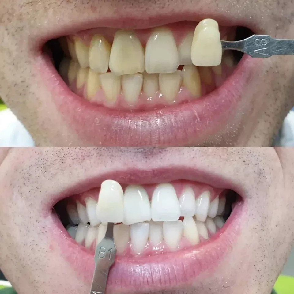 Maarc Blitz White Bleaching Kit 35 HP Based In-Office Tooth Whitening Kit.