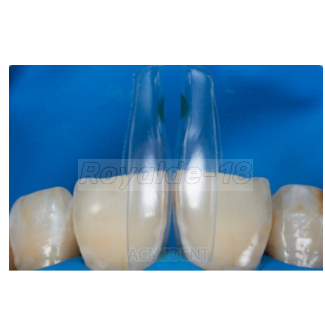 1Box Dental Clear Matrix BT Matrices Black Triangle Wedge Diastema Fits BioClear