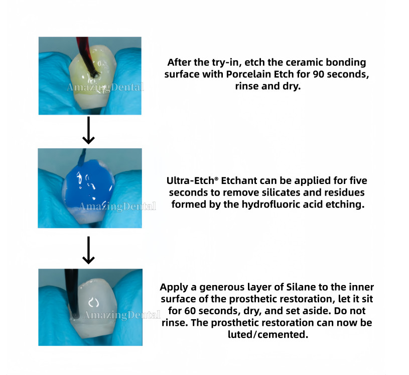 Ultradent Porcelain Etch and Silane Etching 9% Hydrofluoric Acid Ceramic Bonding