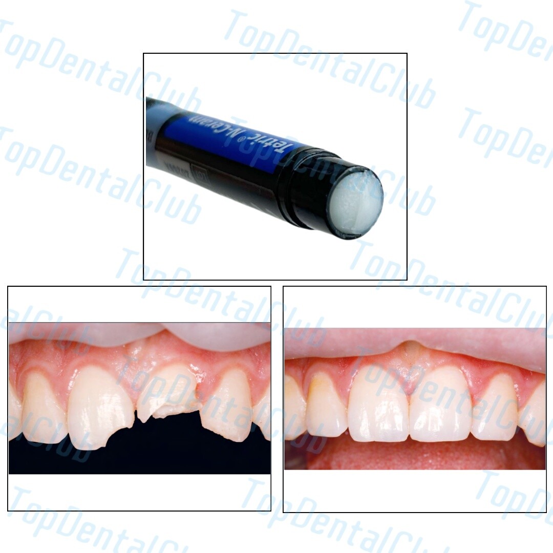 BLL Dental Tetric N-Ceram Composite Resin BL L Bleach L Color Whitening Veneer