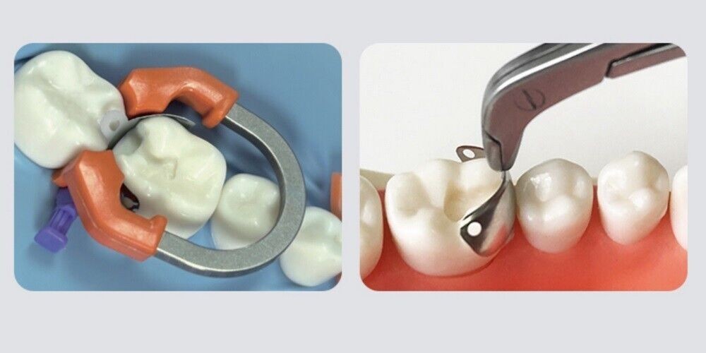 Dental Sectional Matrix Band Nickel Titanium Niti Clamp Ring Universal Separator
