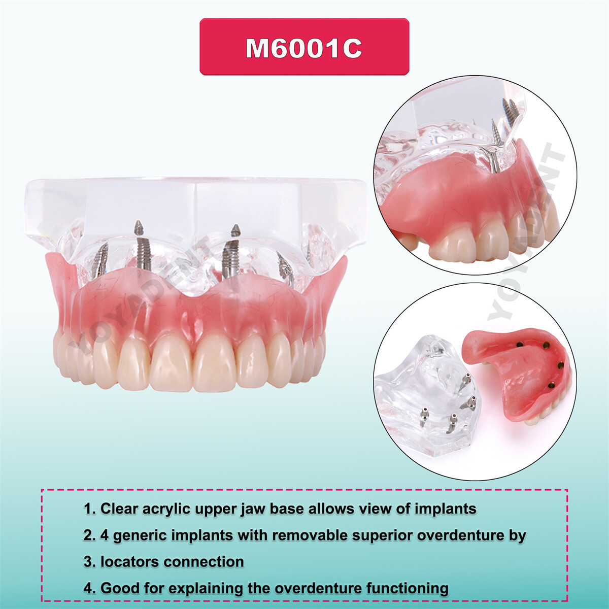 Dental Implant Teeth Demo Overdenture Restoration With 4 Implants Upper/Lower US