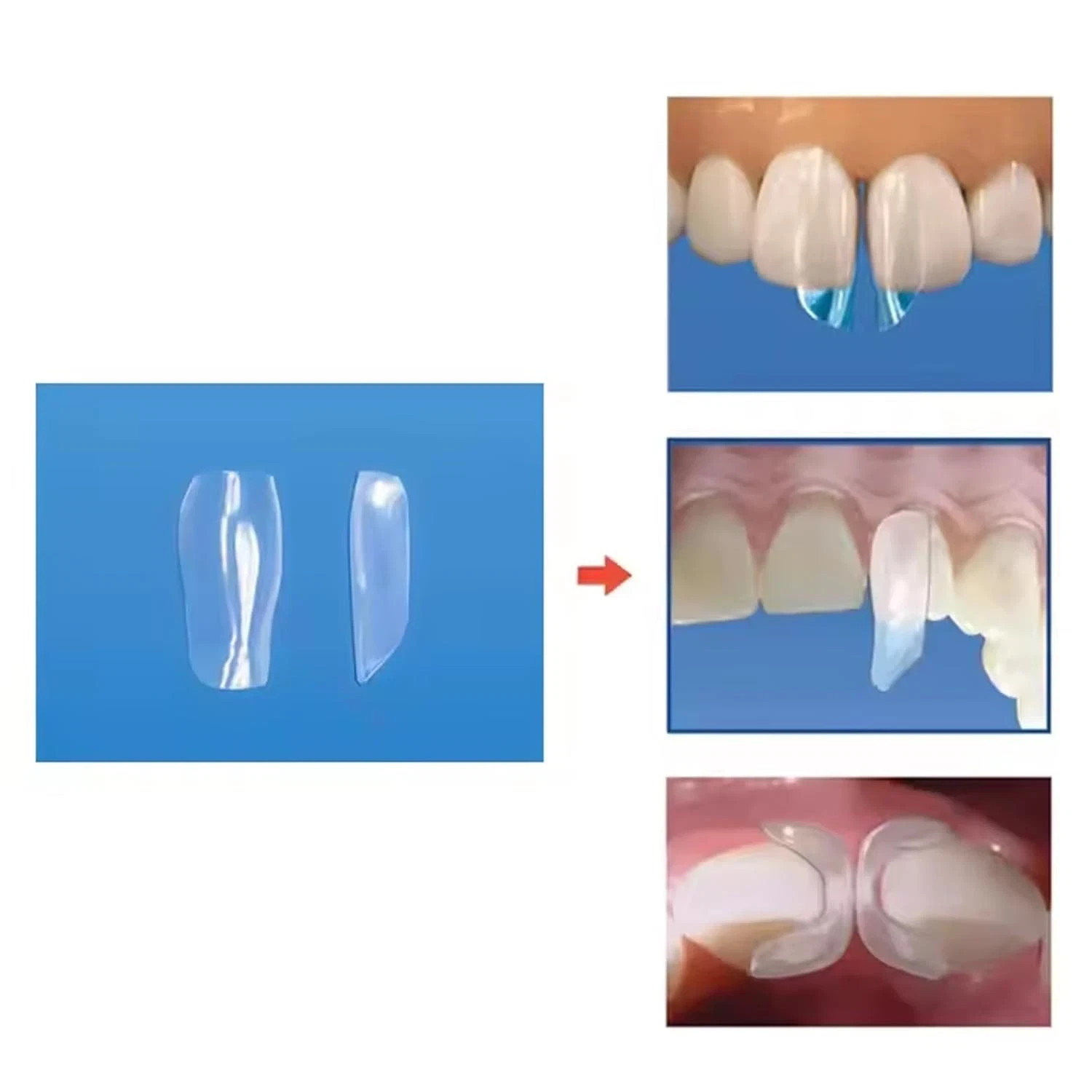 Dental Clear Matrix TOR VM Anterior Matrices Bow BT Matrices Fits Bioclear L/M/S