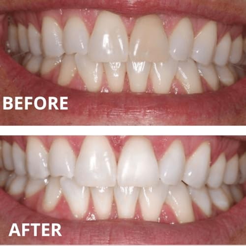 Expertwhite Teeth Whitening Gel Refills (6-gels). Made 0.1 Fl Oz (Pack of 6)