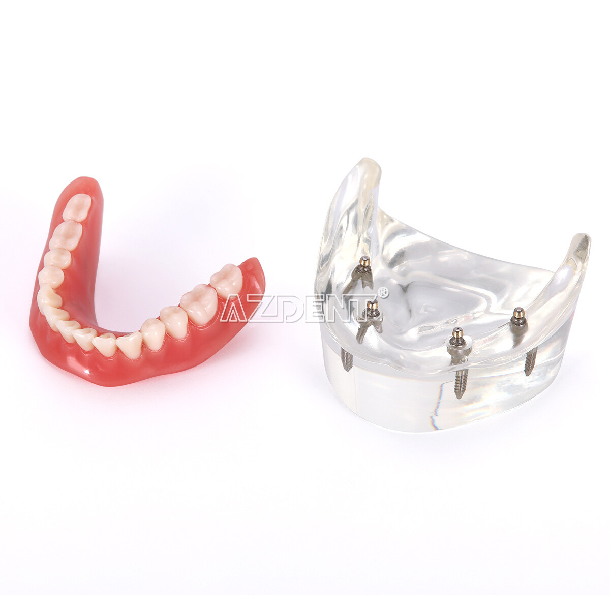 Dental Implant Teeth Model Demo Overdenture Restoration with Implants U/L 2 4