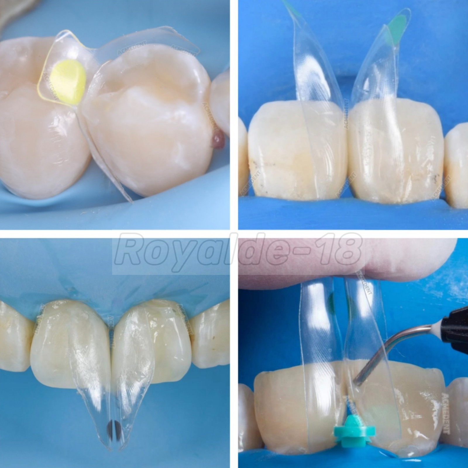 1Box Dental Clear Matrix BT Matrices Black Triangle Wedge Diastema Fits BioClear
