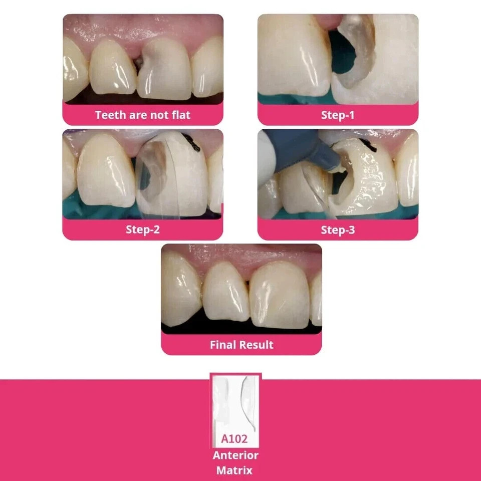 BioClear Anterior Kit Modern Matrix System for Esthetic Restorations FRESH STOCK