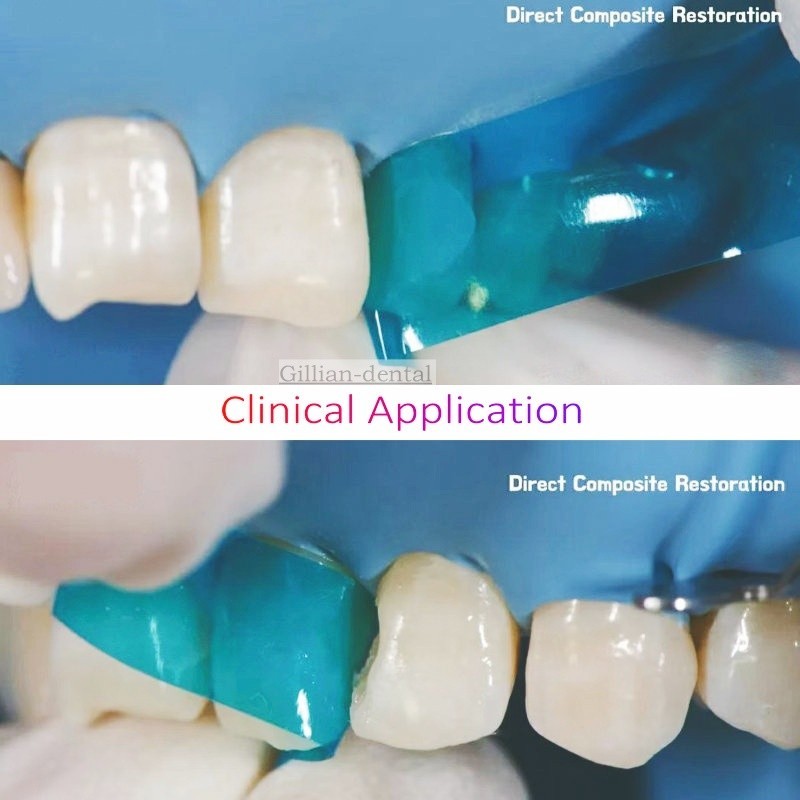 50x Dental Blue Strip M8 Contoured Anterior Matrix Restoration Matrices 0.05mm