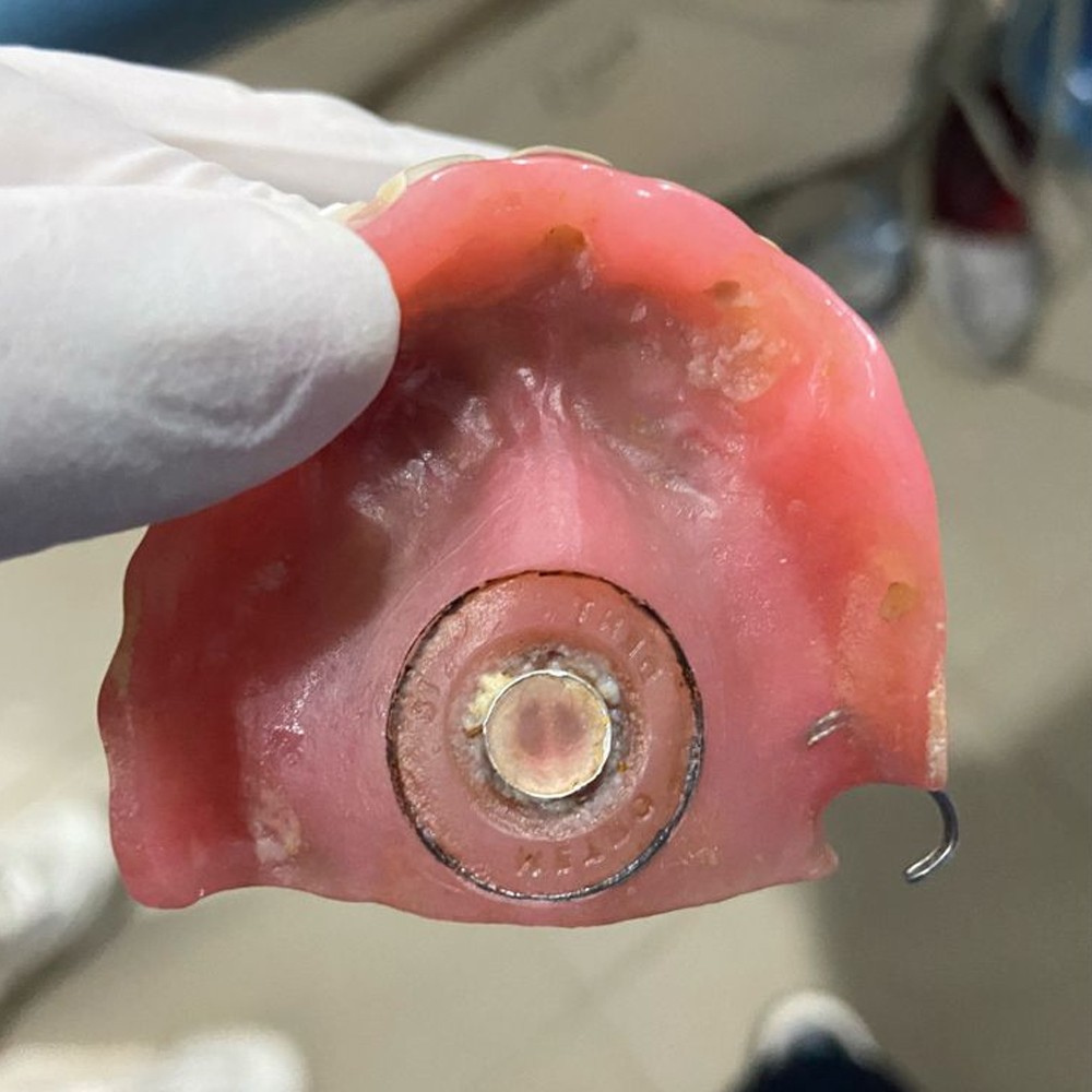 MDM Y – Dents Denture Suction Chamber Discs