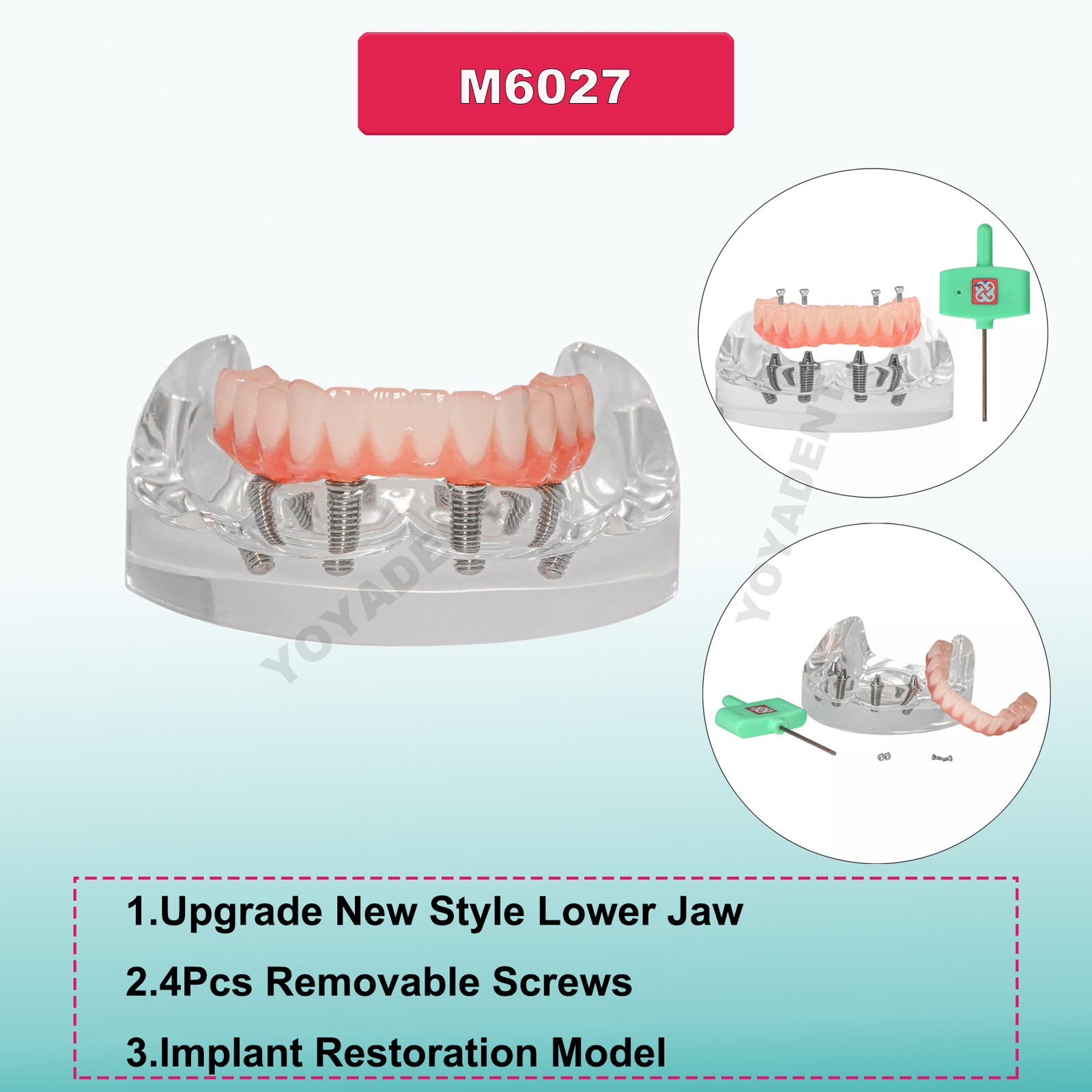 US Dental Teeth Model Overdenture Inferior Implants Demo Upper/Lower Detachable